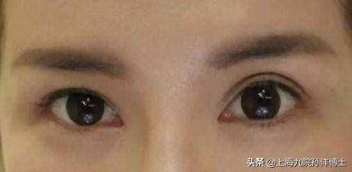 眼修復(fù)孫灃博士：全切雙眼皮修復(fù)是怎么做的呢？