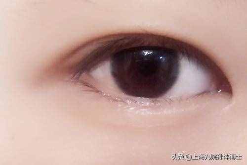 眼修復(fù)孫灃博士：全切雙眼皮修復(fù)是怎么做的呢？