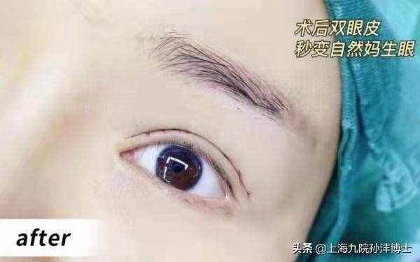 眼修復(fù)孫灃博士：全切雙眼皮修復(fù)是怎么做的呢？