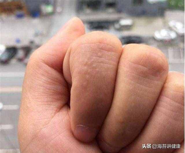 手上老是長“小水泡”？可能是這里出了問題，別再傻傻忽視了