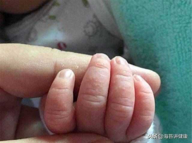 手上老是長“小水泡”？可能是這里出了問題，別再傻傻忽視了