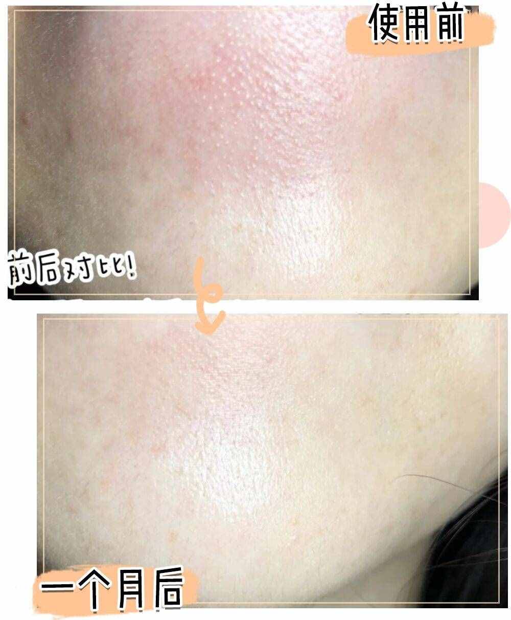 十幾塊搞定痘痘粉刺，你還不知道嗎？