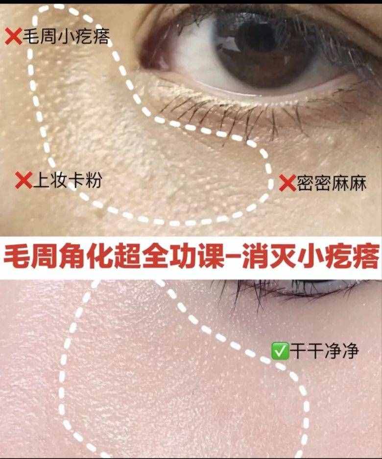十幾塊搞定痘痘粉刺，你還不知道嗎？