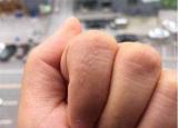 今日更新手上起小水泡什么原因（手上老是長(zhǎng)小水泡）