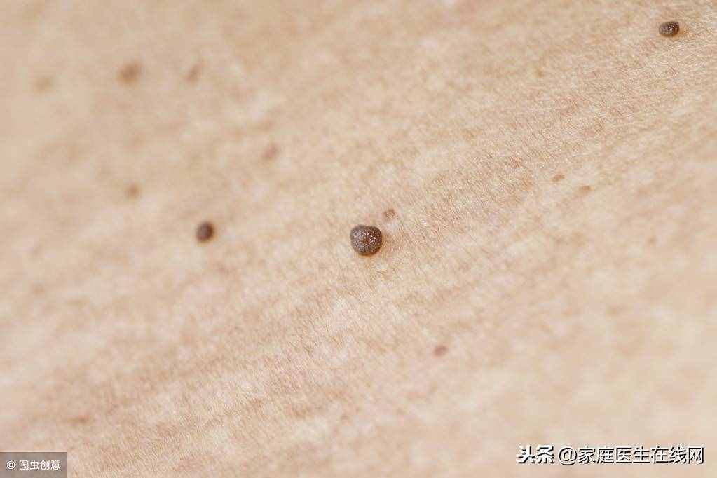 身上長了扁平疣怎么辦？這3個方法，總有一個能“根治”