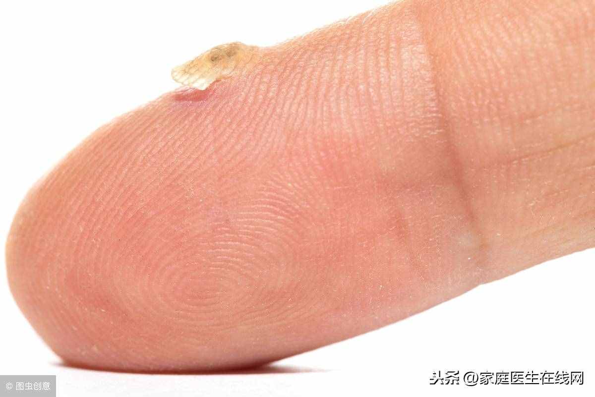 身上長了扁平疣怎么辦？這3個方法，總有一個能“根治”