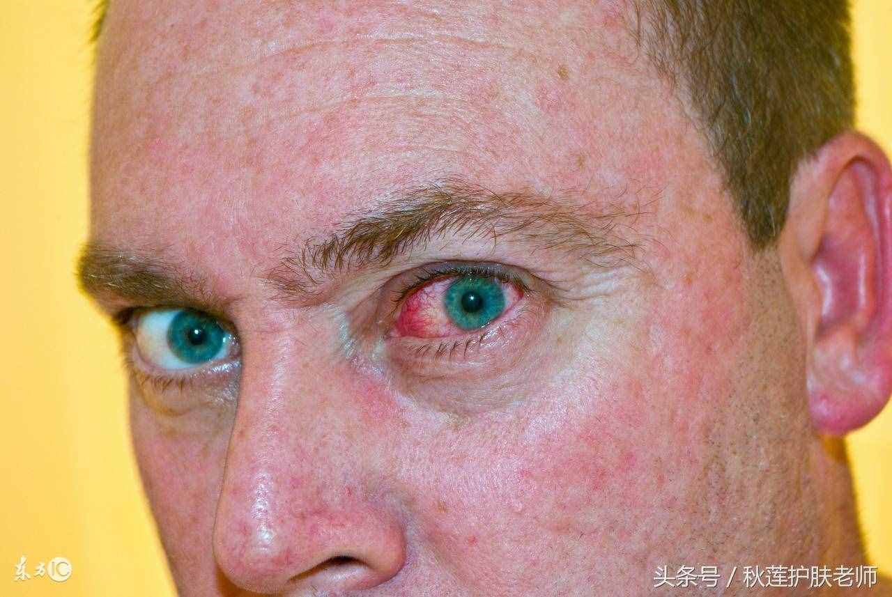 原來(lái)紅血絲是不會(huì)遺傳的！那先天紅血絲怎么來(lái)的？可以治好嗎？
