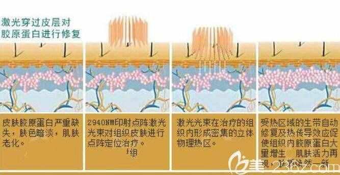 點(diǎn)陣激光祛痘坑原理介紹