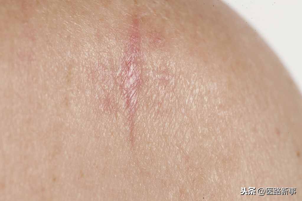 什么是鱗癌？哪些部位容易得呢？日?？梢灶A(yù)防嗎？趕快來了解