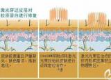 今日更新點(diǎn)陣激光祛痘坑（直擊5次點(diǎn)陣激光祛痘坑效果圖）