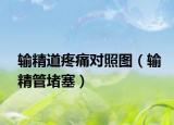 輸精道疼痛對照圖（輸精管堵塞）
