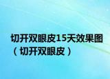 切開(kāi)雙眼皮15天效果圖（切開(kāi)雙眼皮）