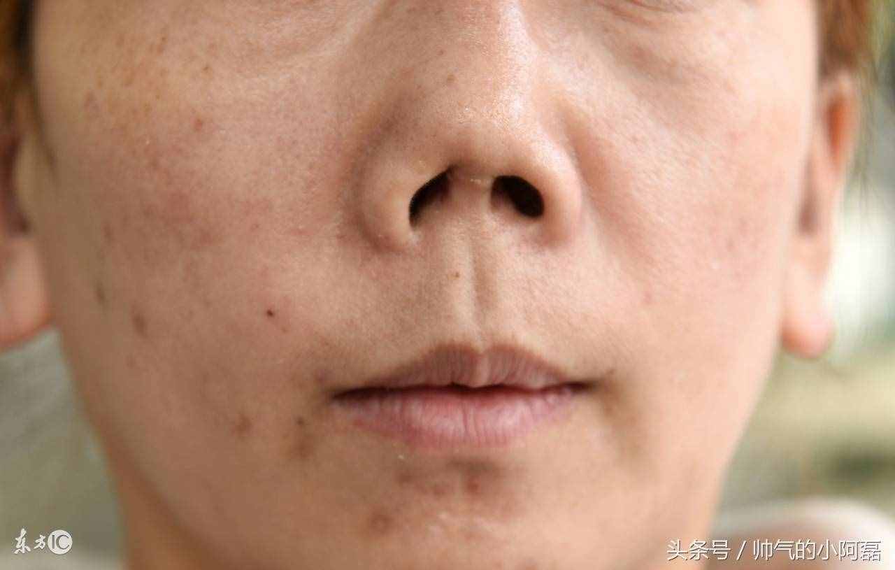 看完假體隆鼻的這3個危害 你再好好考慮