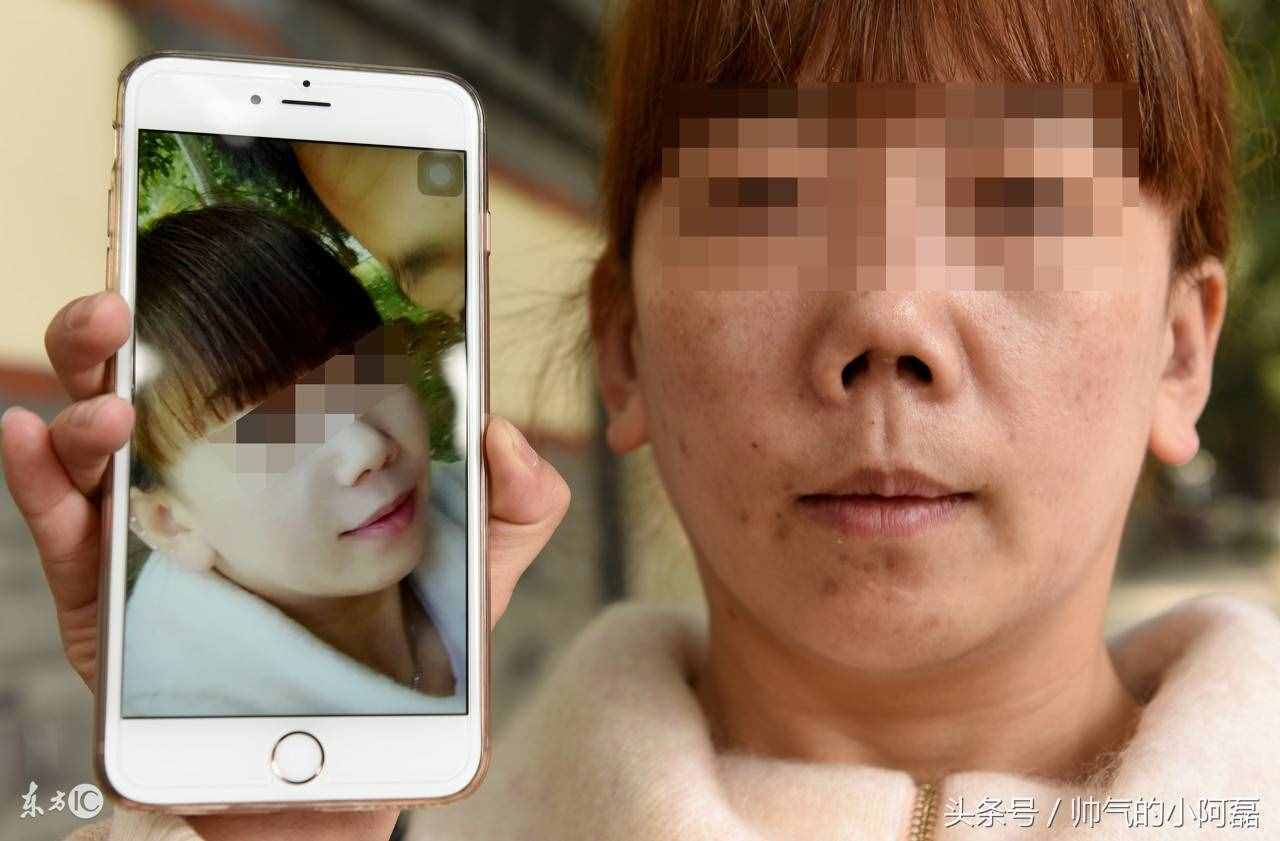 看完假體隆鼻的這3個危害 你再好好考慮