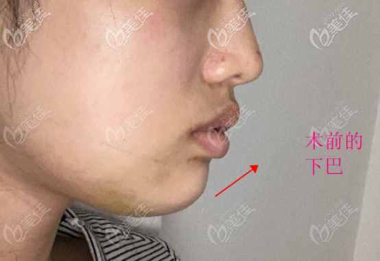 我親身經(jīng)歷人工骨墊下巴的術(shù)前樣子