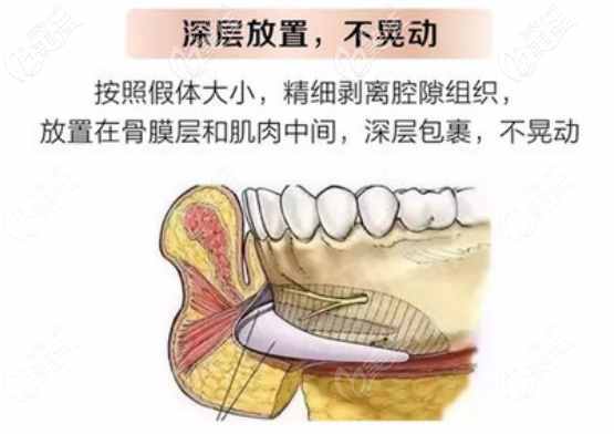 人工骨墊下巴放置的層次