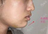 墊下巴多長(zhǎng)時(shí)間恢復(fù)（墊下巴多少錢）