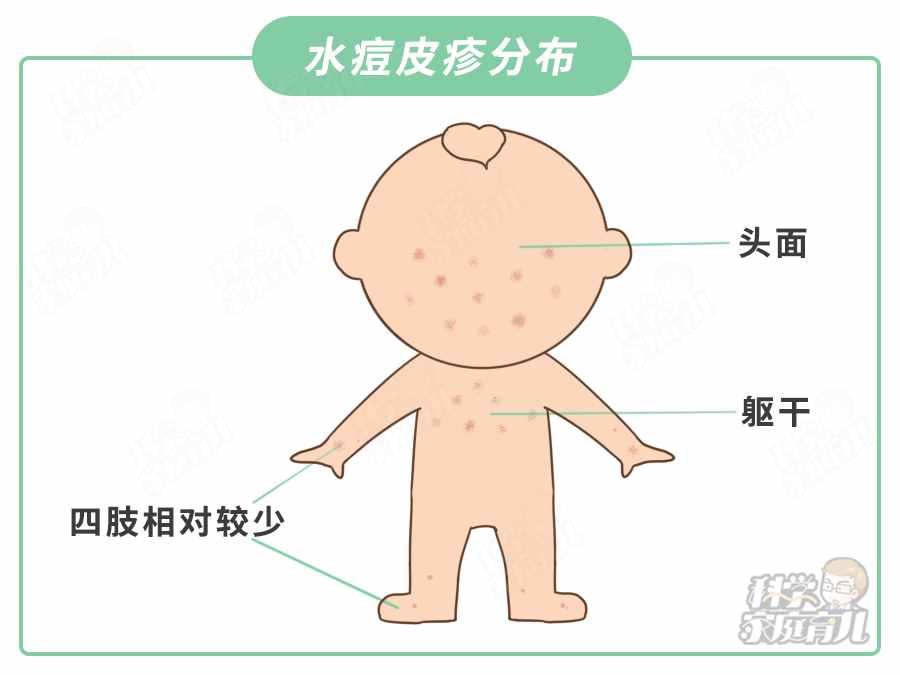 春季水痘爆發(fā)！22名學生確診！娃出現(xiàn)這種情況，趕緊隔離