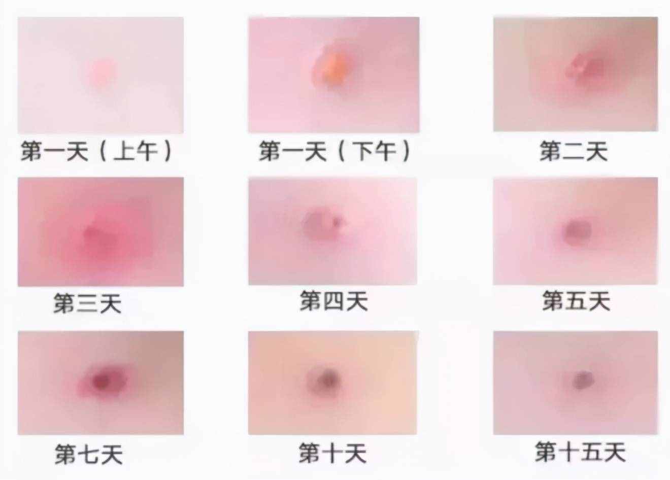 春季水痘爆發(fā)！22名學生確診！娃出現(xiàn)這種情況，趕緊隔離