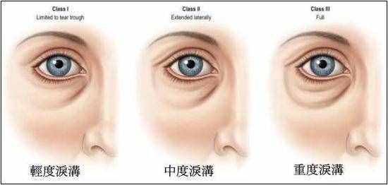 不再為淚溝發(fā)愁，這些方法可以徹底消除它們