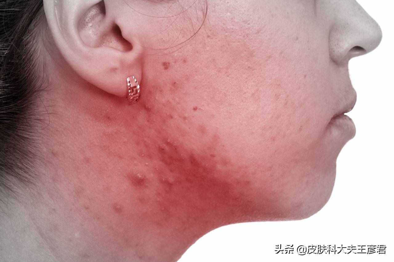 臉上痘痘變硬的原因及其解決方案