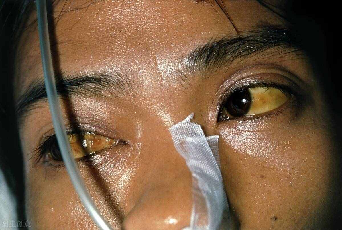 肝癌死亡率達(dá)70％，知道肝癌的八個(gè)征兆 早發(fā)現(xiàn)早治療