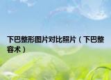 下巴整形圖片對比照片（下巴整容術）