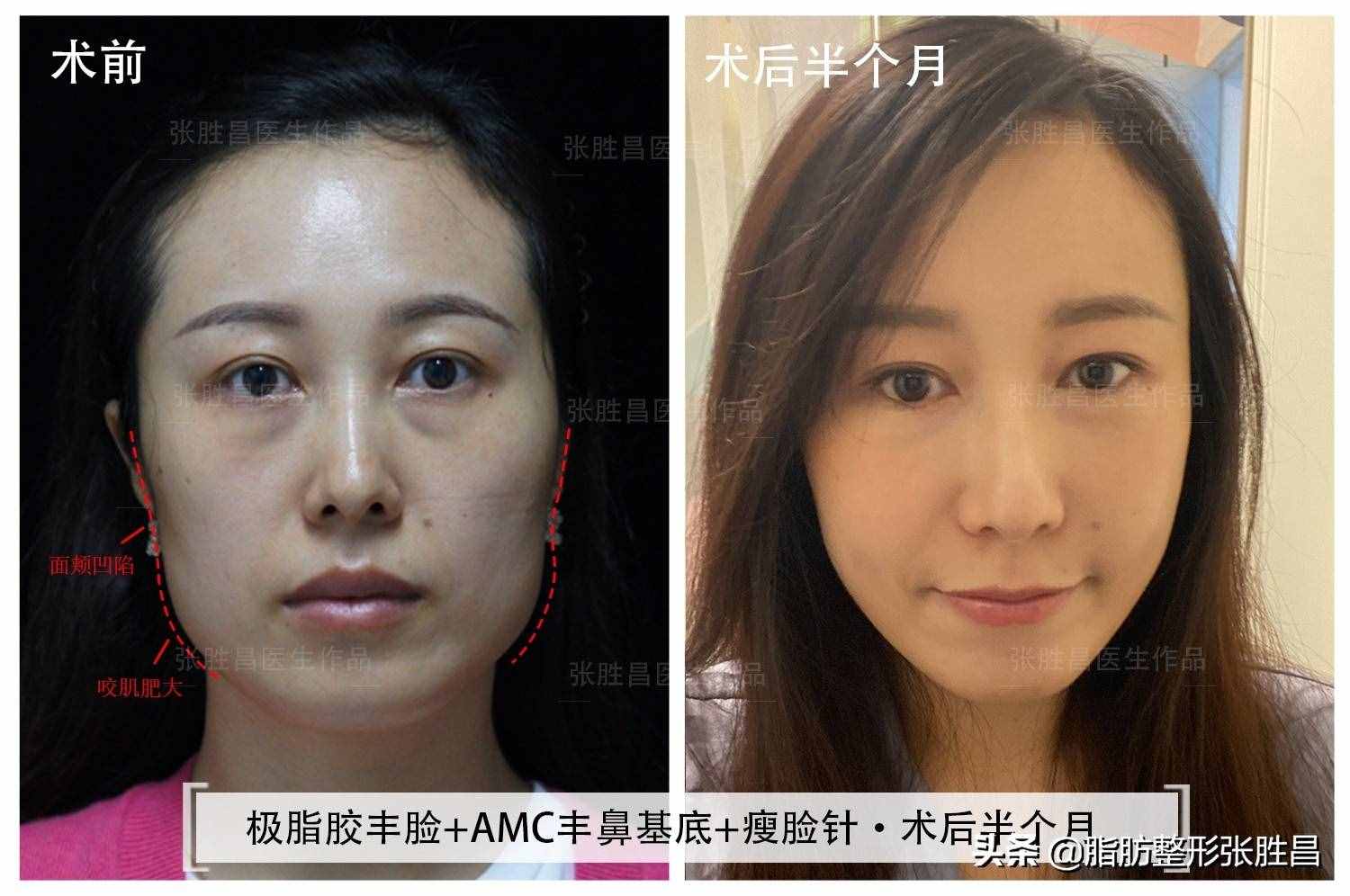 一次瘦臉針能保持多久？哪6類人不能打？經(jīng)常注射的醫(yī)生這樣說