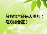 馬方綜合征病人圖片（馬方綜合征）