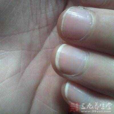 指甲上出現(xiàn)白點暗示健康亮“紅燈”