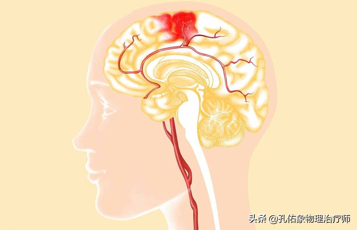 為何如此多的人發(fā)生腦出血？要如何正確應(yīng)對(duì)？一文詳細(xì)告知您