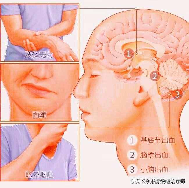 為何如此多的人發(fā)生腦出血？要如何正確應(yīng)對(duì)？一文詳細(xì)告知您