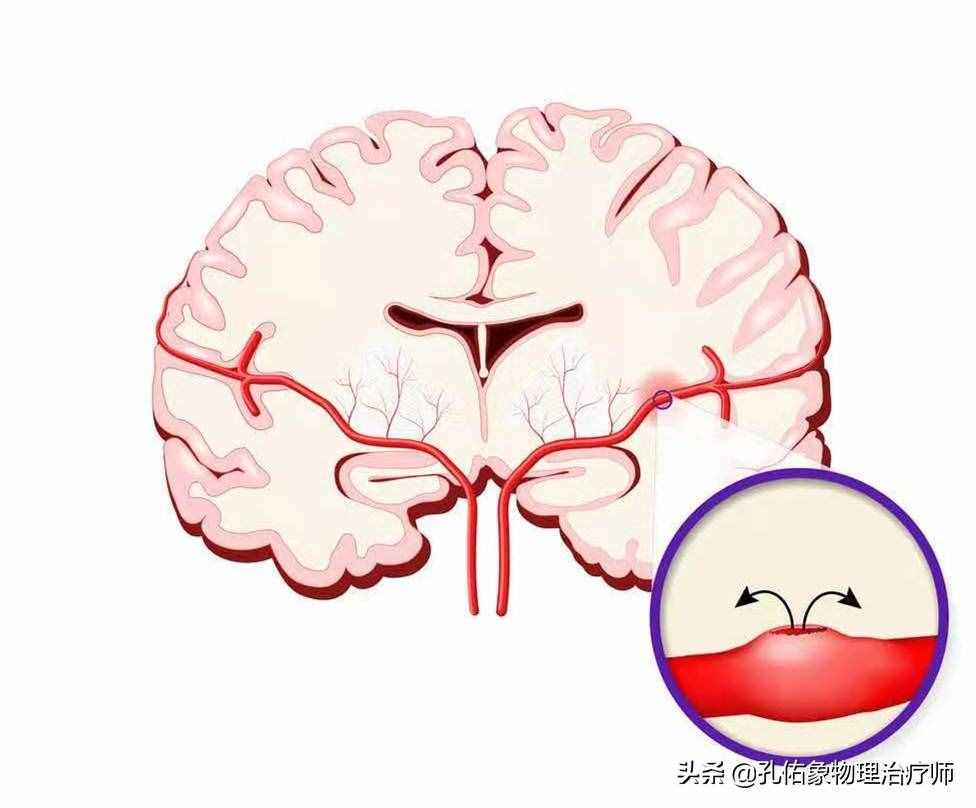 為何如此多的人發(fā)生腦出血？要如何正確應(yīng)對(duì)？一文詳細(xì)告知您