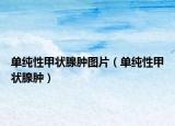 單純性甲狀腺腫圖片（單純性甲狀腺腫）