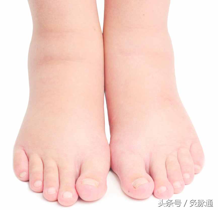 老人腳腫就用艾灸，辯證消腫效果好