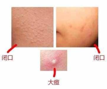 粉刺是什麼，怎麼消除
