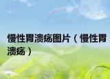 慢性胃潰瘍圖片（慢性胃潰瘍）