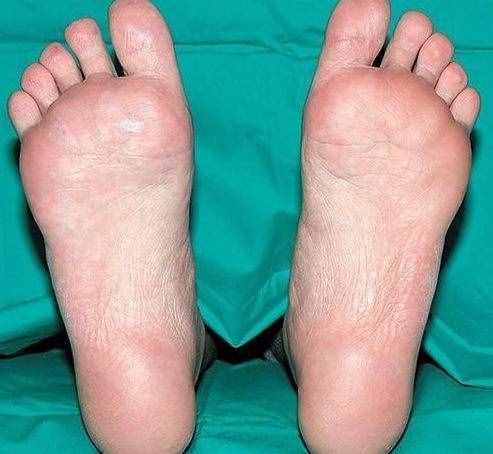 常見(jiàn)的幾種足底疼痛，哪些原因引起的呢？