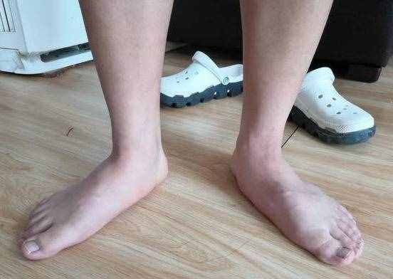 常見(jiàn)的幾種足底疼痛，哪些原因引起的呢？