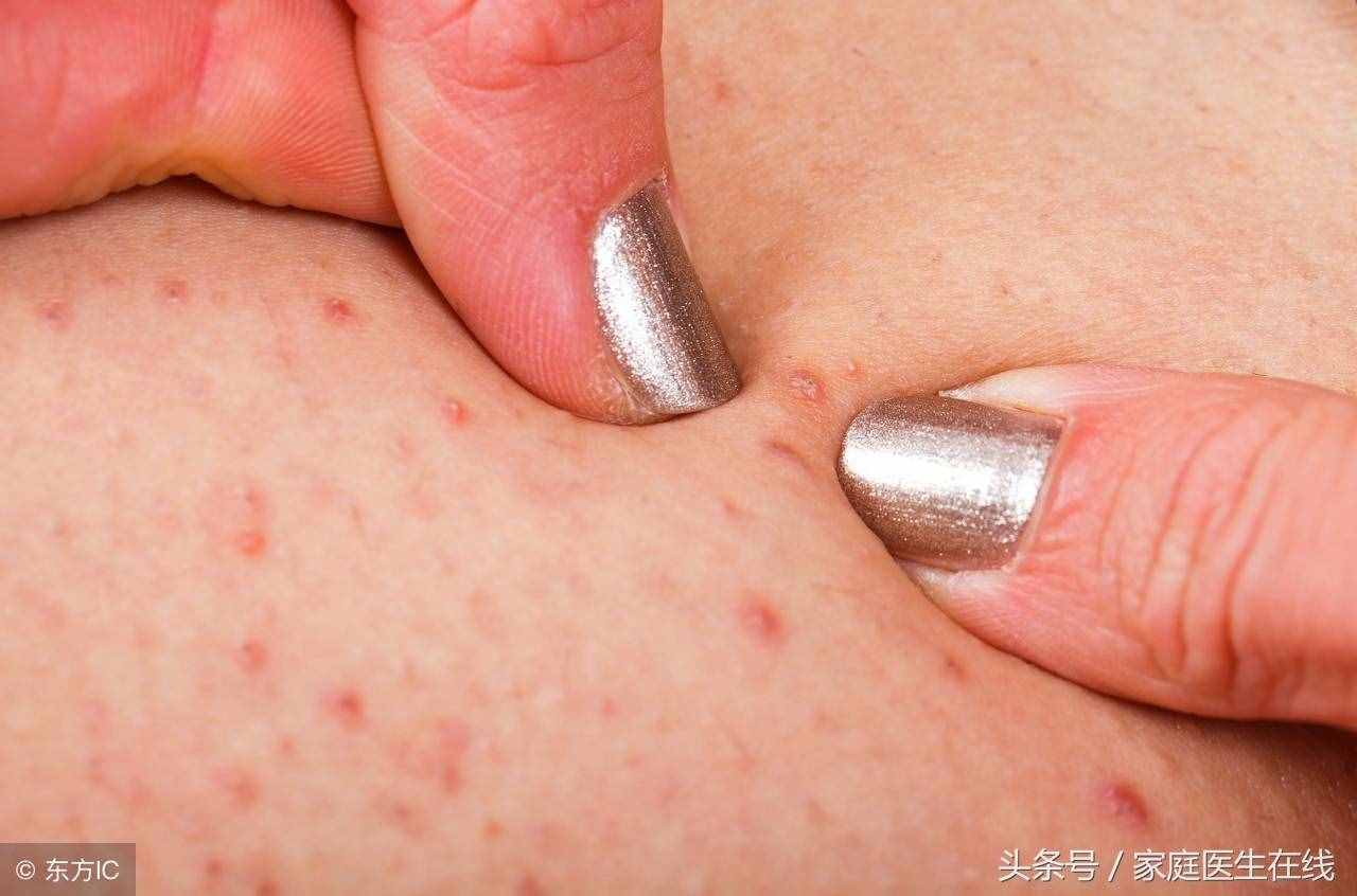 患上毛囊炎該怎么辦？這些方法，是過來人的經(jīng)驗