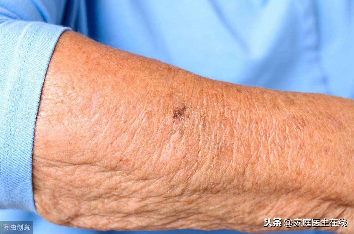老年斑會癌變嗎？長了老年斑，這幾個方法或許能去除