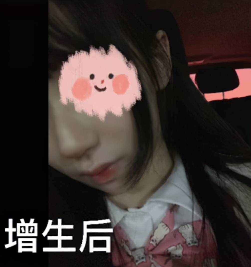 千萬(wàn)粉網(wǎng)紅承認(rèn)整容失?。∽猿氨亲佑执笥指呦裎灼?，不停手術(shù)修復(fù)