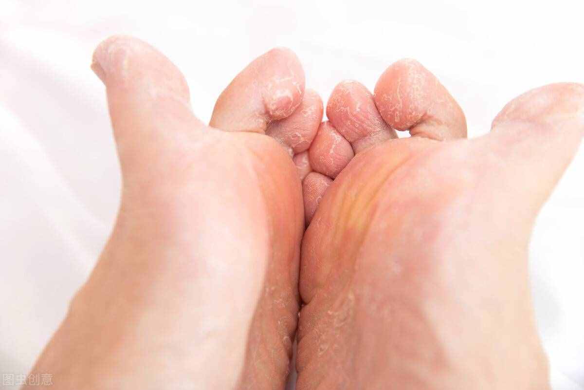 腳氣，如何根除？醫(yī)生教你4個(gè)小方法，簡(jiǎn)單有效祛腳氣