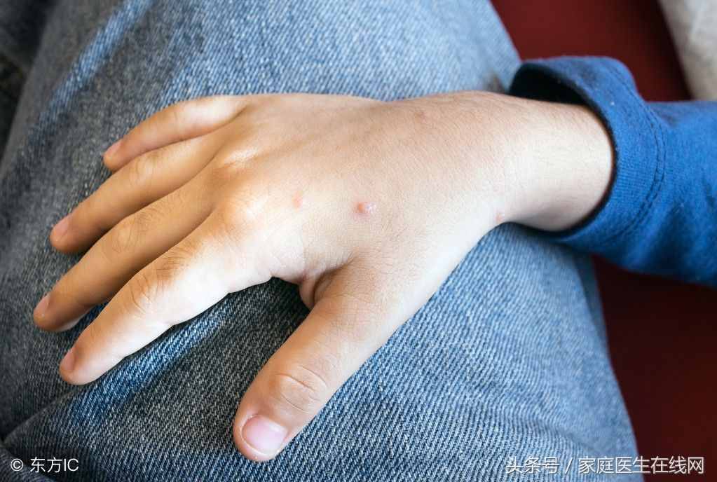 手上長的小水泡到底是什么？這3個小妙招，止癢防復發(fā)