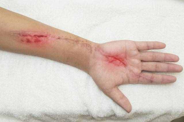 手術疤痕如何去除