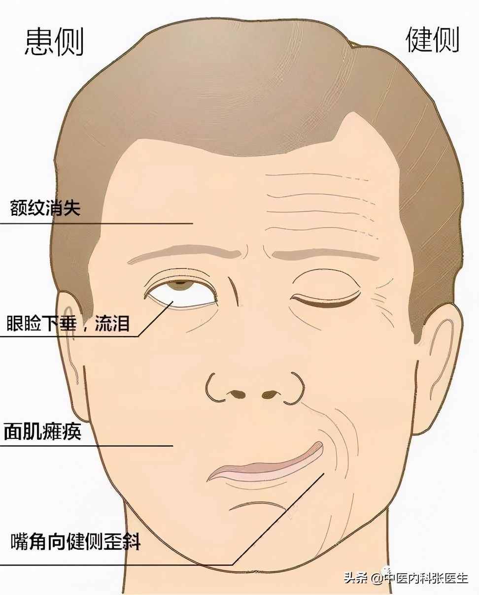 除了口歪眼斜，面癱還會有哪些表現(xiàn)？會有哪些后遺癥？