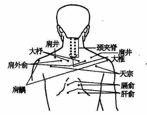 拔火罐能治療頸椎病，為家人收藏起來！