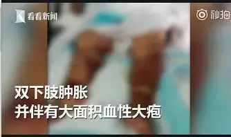 女子被蝦刺破手，12天后去世！被海鮮扎傷手，正確處理方法是這個(gè)