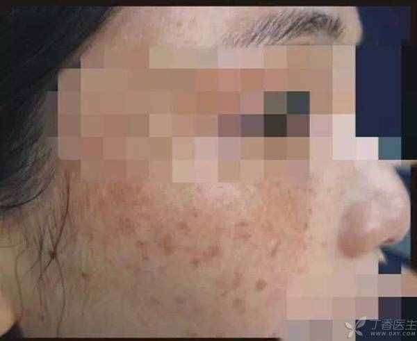 臉上有了斑，該怎么消除？不同的斑點有不同辦法