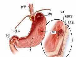 十二指腸炎是什么樣的？有什么樣的表現(xiàn)危害？十二指腸的六大類！